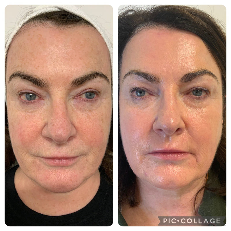 halo laser resurfacing