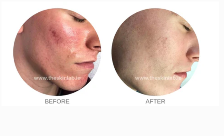 Acne Scarring reduced with micro-needling