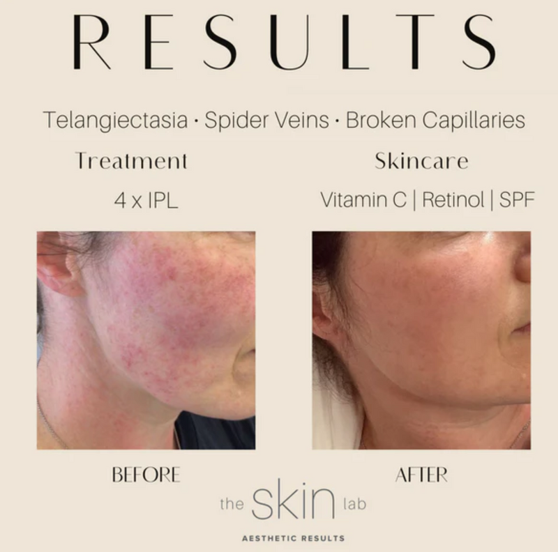 Spider Veins & Broken Capillaries