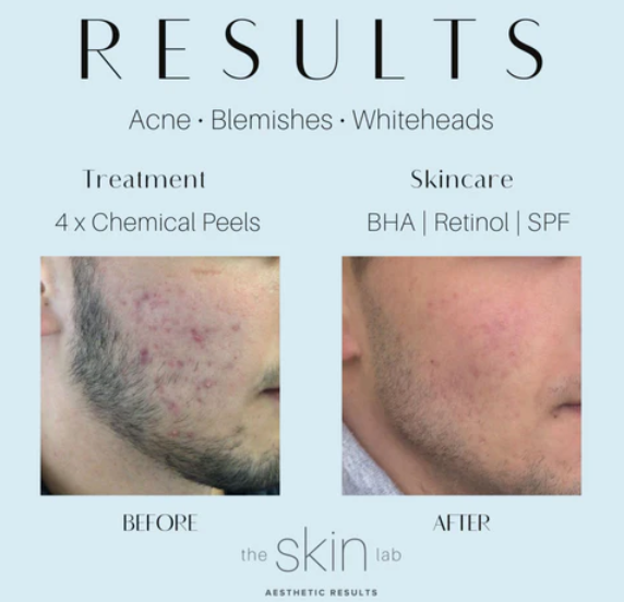 Men Acne Treatment