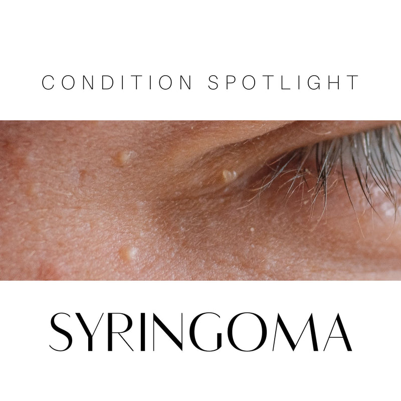 Understanding Syringomas