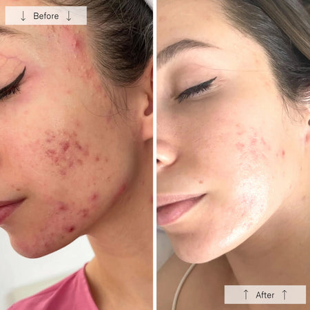 OMNILUX Clear LED Face Mask