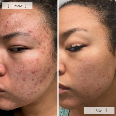 OMNILUX Clear LED Face Mask