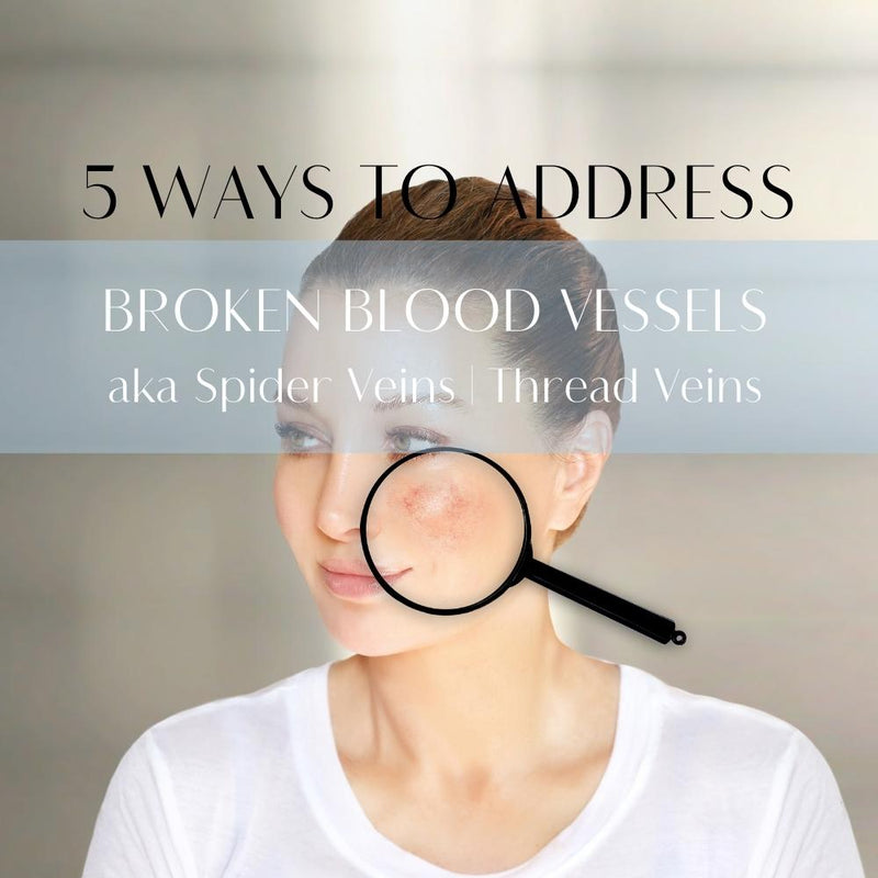 5 Ways to Address Broken Blood Vessels on Your Face