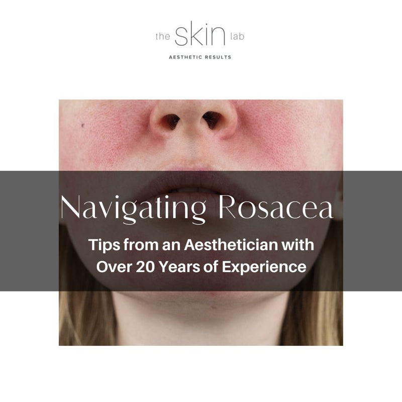 Navigating Rosacea: Tips from an Aesthetician with Over 20 Years of Experience