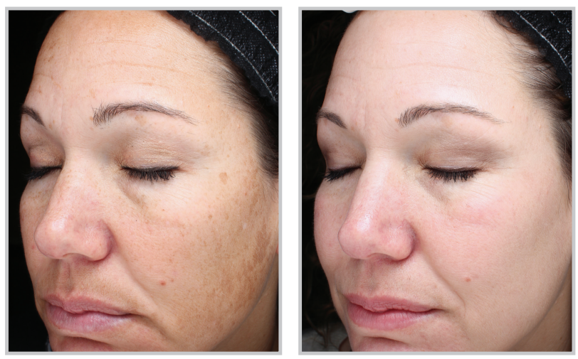 Lady showing before and after results of HALO laser treatment