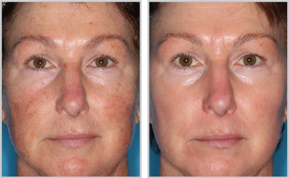 Woman showing results before and after HALO laser treatment