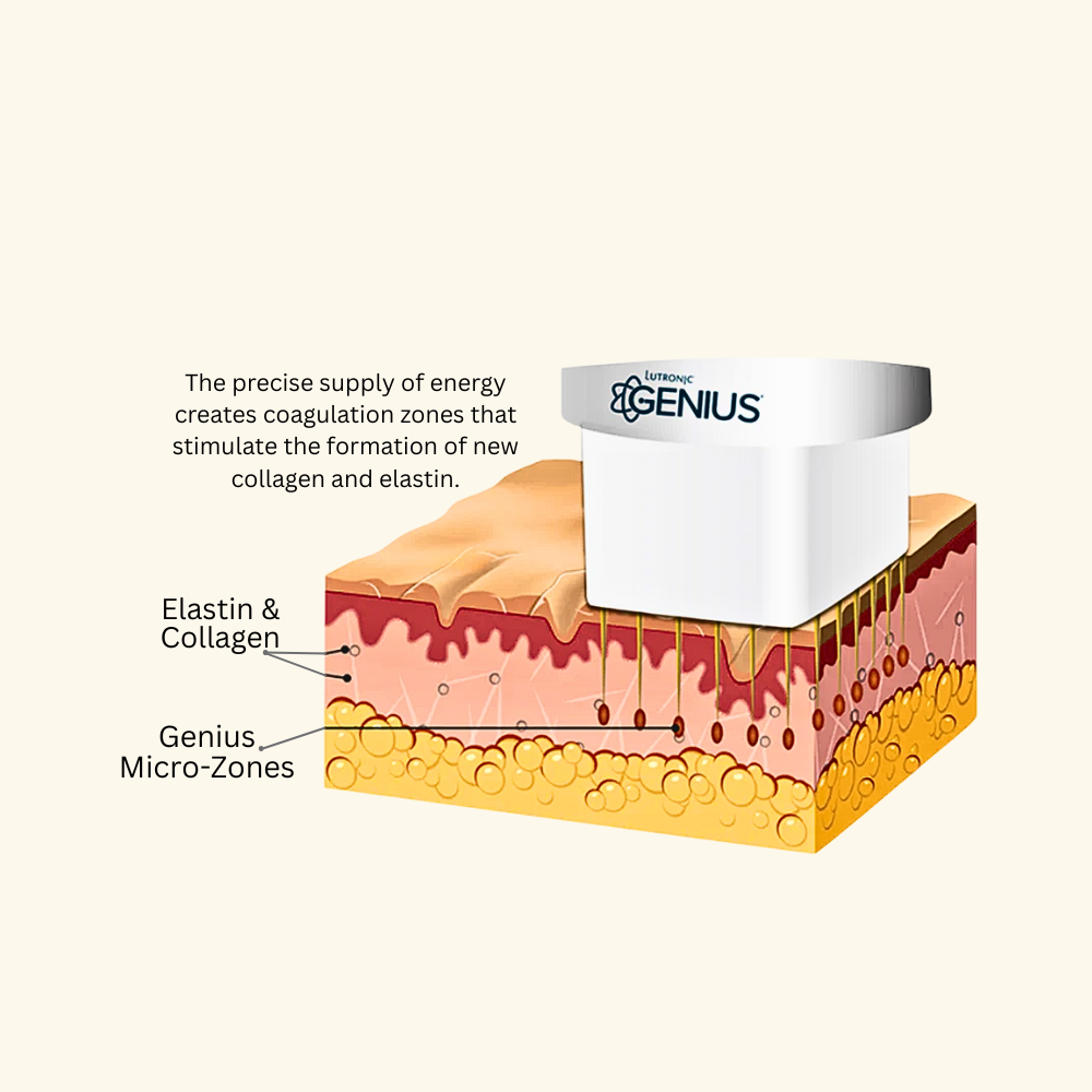 How Is It Different from Traditional Microneedling?